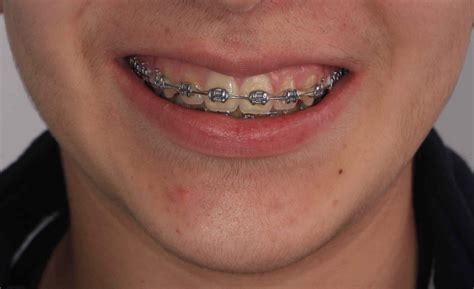 precios brackets metalicos y esteticos|ortodoncia brackets precio.